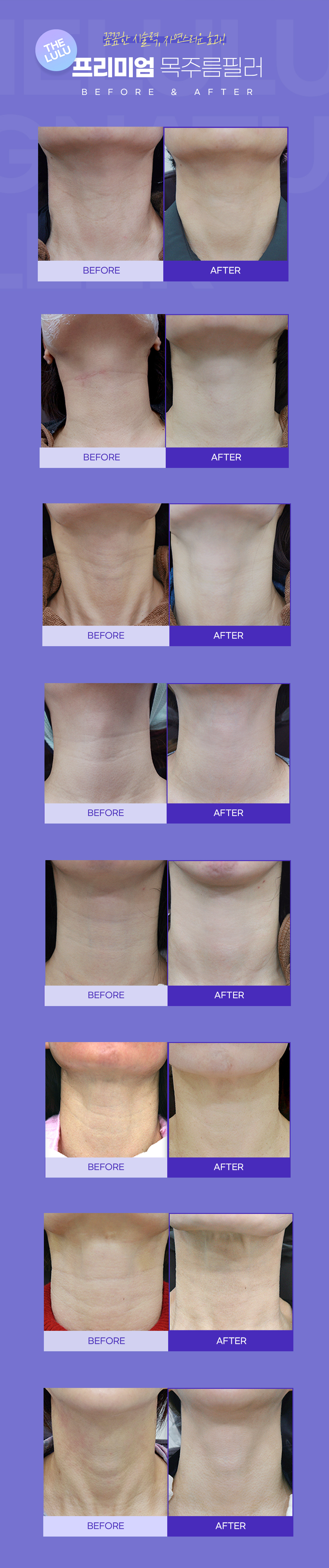 더루루 목주름 필러의 특별한 점. 절개가 없는 간단한 시술, 1~2주 이내에 호전되는 효과, 깊어진 피부층의 재생을 도움, 유지기간이 1년 이상, 주름이 서서히 희미해져 자연스럽게 젊어지는 효과