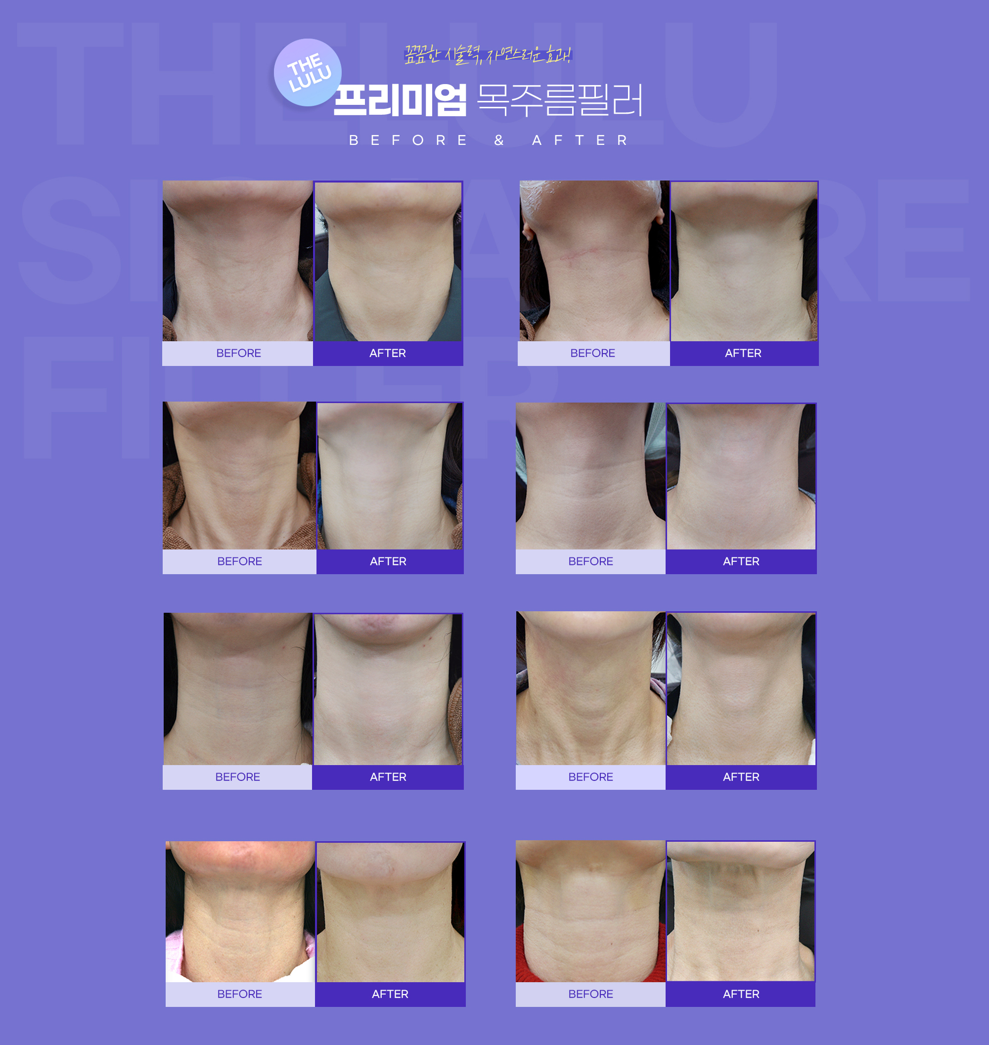 더루루 목주름 필러의 특별한 점. 절개가 없는 간단한 시술, 1~2주 이내에 호전되는 효과, 깊어진 피부층의 재생을 도움, 유지기간이 1년 이상, 주름이 서서히 희미해져 자연스럽게 젊어지는 효과